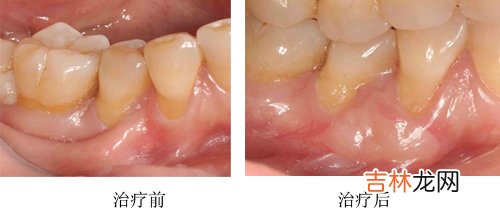 唇带附丽过低有什么影响