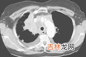 白塞病伴发Budd-Chiari综合征死亡一例