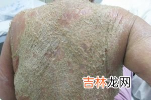 发疹型药疹患者血清肿瘤坏死因子α的检测