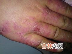 多磺酸基粘多糖乳膏治疗冻疮疗效观察