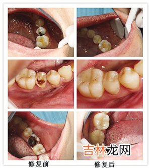 牙齿自检应每半年一次