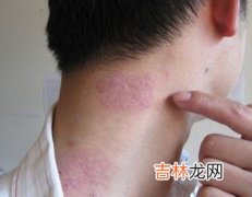 银屑病患者血清抗重组85复合抗原体的检测及其意义