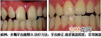 美学与正常牙合有什么关系