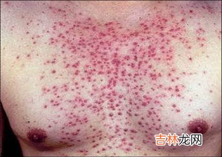 银屑病患者皮肤鳞屑真菌的分离及流式细胞计数分析