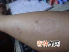 银屑病患者生长抑素的定量定位检测