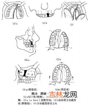 如何预防颌间牵引的副作用