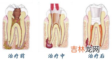 什么样的牙需要根管治疗