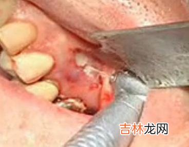 怎样做根尖切除术
