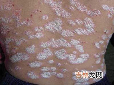 第七届国际银屑病学术会议介绍