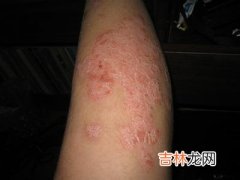 β溶血型链球菌诱发点滴型银屑病发病机制的研究