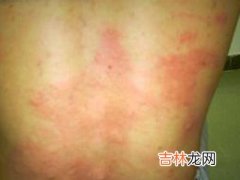 202例药疹住院病例临床特征分析