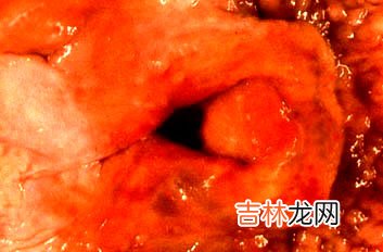 喉水肿的常见病因症状和处理方法有哪些