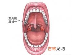 扁桃体摘除术的适应症是什么