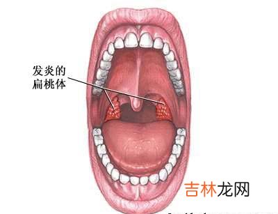 扁桃体摘除术的适应症是什么