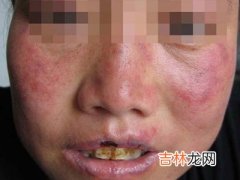 系统性红斑狼疮伴肌炎的临床研究