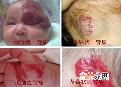 倍频NdYAG治疗皮肤血管瘤等100例分析