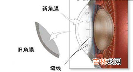 角膜移植术有哪几种术式适应症如何