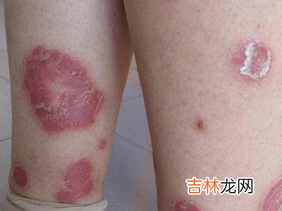 中草药治疗急性痘疮样苔藓样糠疹九例