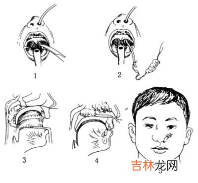 鼻出血的处理措施及治疗方法有哪些