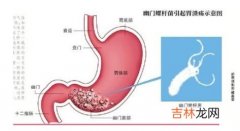 幽门螺杆菌与荨麻疹的关系探讨