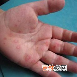 小儿过敏性紫癜62例分析