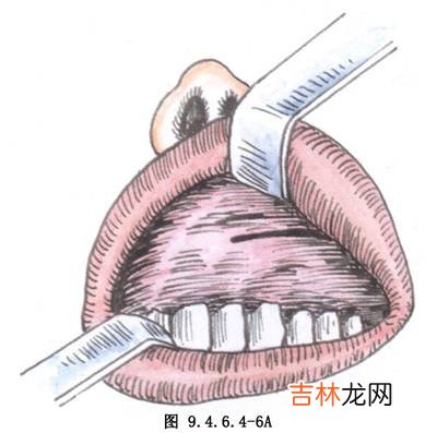 上颌窦根治术的适应症是什么