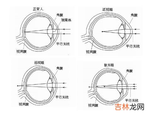 什么是弱视呢