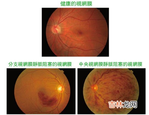 治疗视网膜静脉阻塞有哪些方法