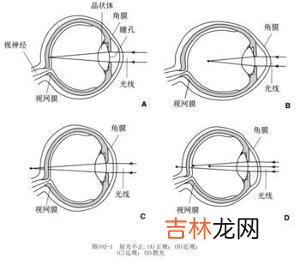 近视眼是怎样分类的