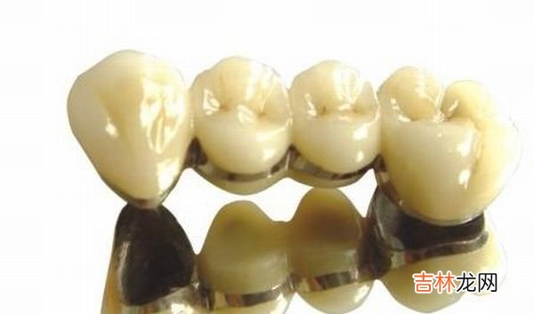 粘结固定桥好吗