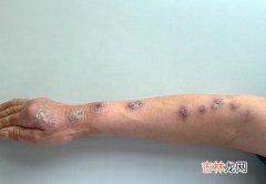 碘化钾预防孢子丝菌病的实验研究