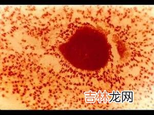 肺癌合并曲霉感染二例