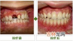 固定修复的基牙怎样选择