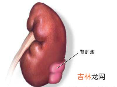 小汗腺血管瘤样错构瘤一例