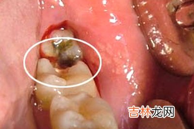 食物嵌塞是食物嵌入