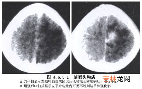 皮肤裂头蚴病一例