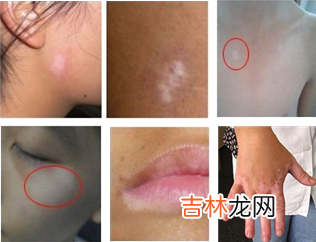 节段型白癜风皮损区角朊细胞表达碱性成纤维细胞生长因子的观察