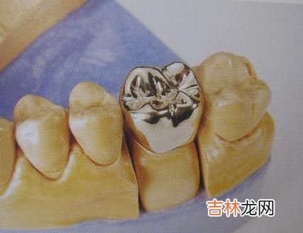 什么是与铸造冠有什么差别