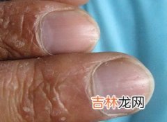 大疱型肥大细胞增生病一例