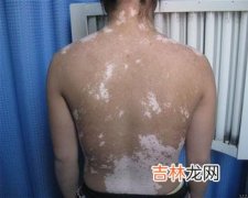 白癜风患者血清抗黑素瘤细胞抗体的检测