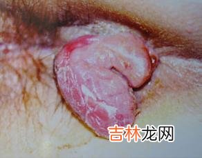 人乳头瘤病毒18型E6E7反义RNA表达重组体的构建