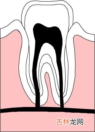 牙敏感症的防治
