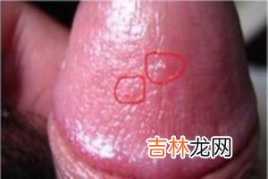包皮环切术减少生殖器疱疹的复发