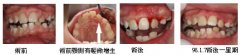 怎样做牙龈切除术