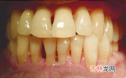 怎样拟定牙周病的治疗计划