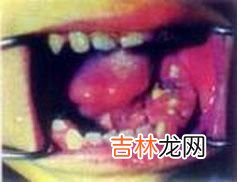 怎样鉴别牙周脓肿和牙槽脓肿