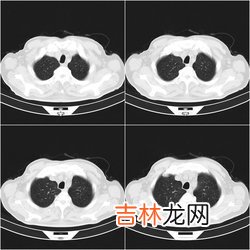 以皮肤结节为首发症状的急性单核细胞性白血病一例