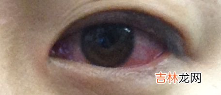 眼球内异物的处理原则有哪些