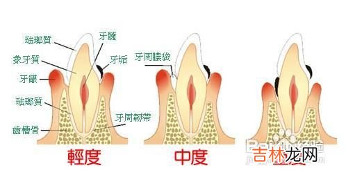 怎样做袋壁刮治术