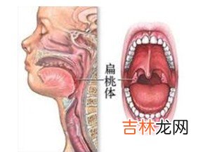 皮肌炎并发心包炎一例